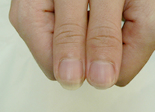 nail fungus treatment nyc